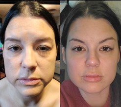 Before and after facial treatment