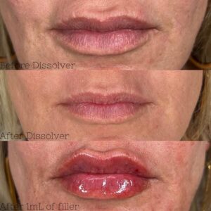 mind body and soul medical 3 lip before and after