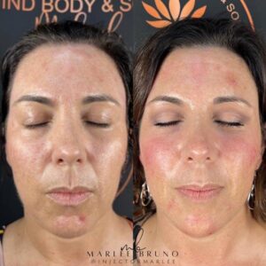 mind body and soul medical before and after facial rejuvenation