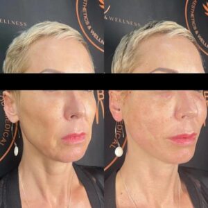 mind body and soul medical older facial before and after