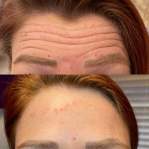 Before and After Botox Forehead