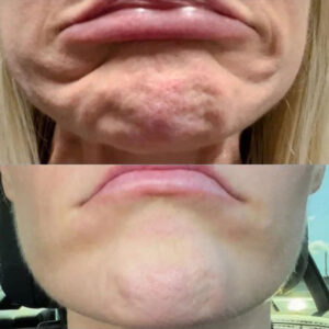 Before and After Botox Chin