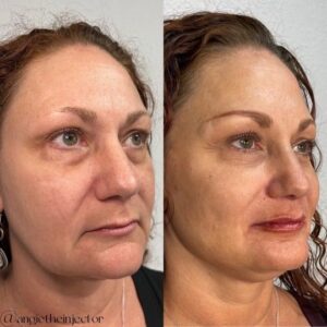 mind body and soul medical full facial before and after