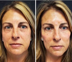 Face filler before and after result