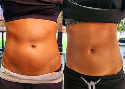 tummy radiasse before and after