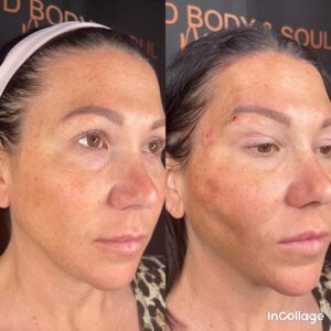 Patient at Mind Body Soul Medical Before & After PDO Threads Treatment