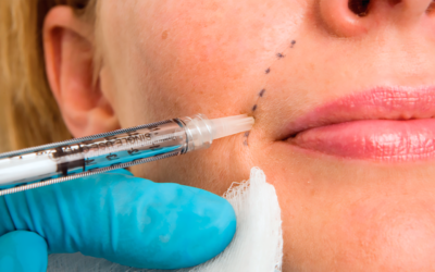 How Long Do Dermal Fillers Last? What to Expect Over Time